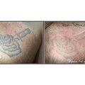 Лазерное выведение татуировки (Киев)