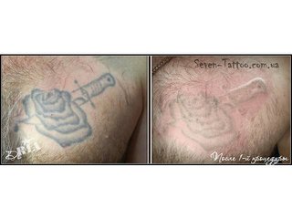 Лазерное выведение татуировки (Киев)
